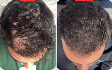 Regrow More Than Hair Regain Your Confidence.
